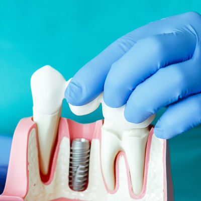 Cirugía e implantes