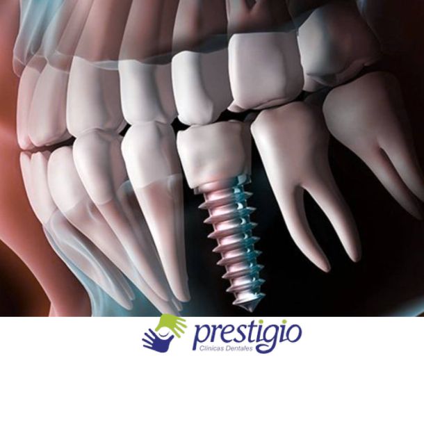 Implante dental en Valdemoro y Parla: Prestigio Dental