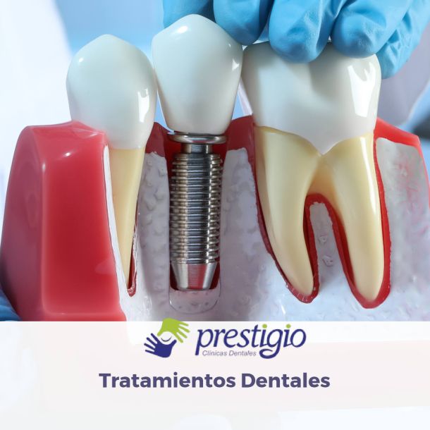 Implante dental en Valdemoro y Parla