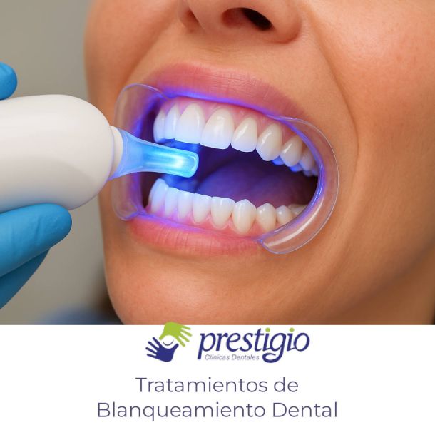Blanqueamiento Dental en Clínicas Prestigio Dental de Valdemoro y Parla